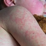 Ognisko odry na Podkarpaciu wciąż aktywne, 18 potwierdzonych zakażeń. "Zalecamy maseczki"