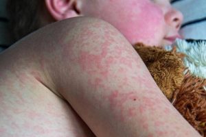 Ognisko odry na Podkarpaciu wciąż aktywne, 18 potwierdzonych zakażeń. "Zalecamy maseczki"