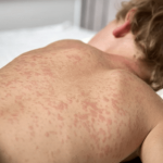 Podkarpacie: 11 przypadków odry. Poznaj kluczowe objawy tej choroby