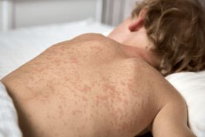 Podkarpacie: 11 przypadków odry. Poznaj kluczowe objawy tej choroby