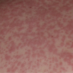 Coraz więcej przypadków odry na Podkarpaciu. Obecnie to już 23 osoby w trzech powiatach