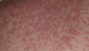 Coraz więcej przypadków odry na Podkarpaciu. Obecnie to już 23 osoby w trzech powiatach