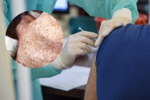 Ognisko odry na Podkarpaciu coraz większe. Sanepid potwierdza kolejne zachorowania